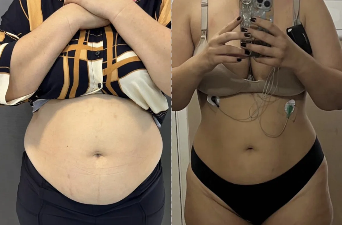 Resultado de Endolaser — abdômen antes e depois