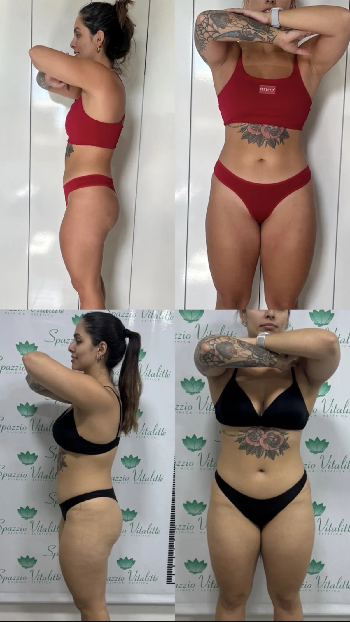 Resultado de Endolaser — contorno corporal antes e depois